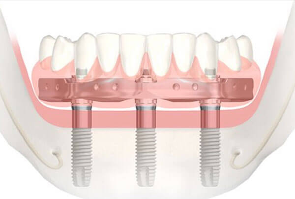 Trefoil Lower Arch Prosthesis Brockville